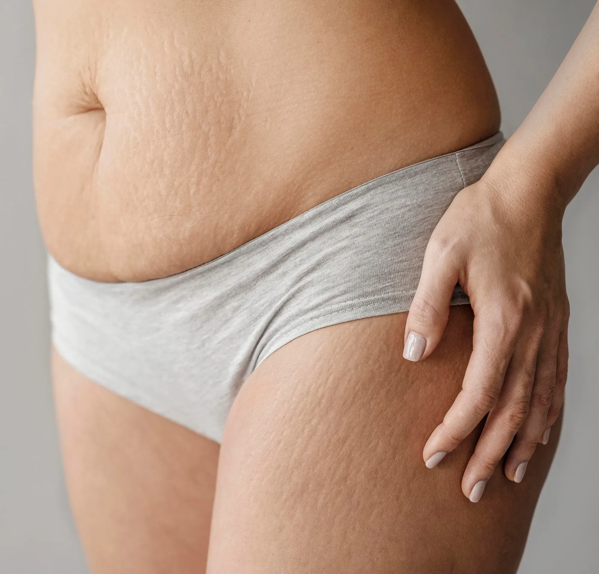 Dehnungsstreifen Behandlung mittels CO2-Laser & Fraktional RF Microneedling