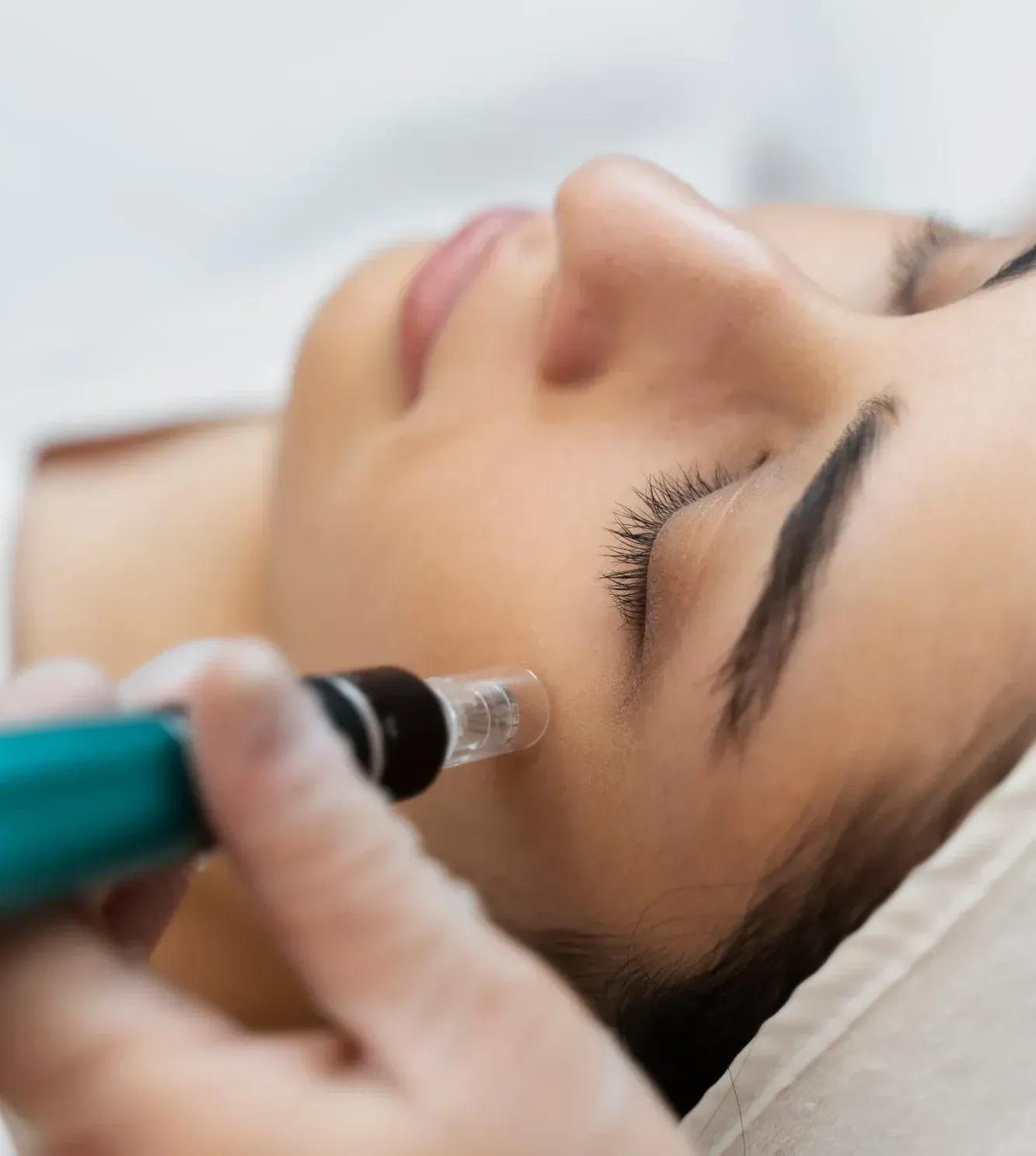 Was versteht man unter Microneedling?