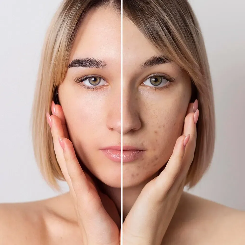 Mesolifting – innovatives Lifting für eine verjüngte und strahlende Haut-Skin Booster