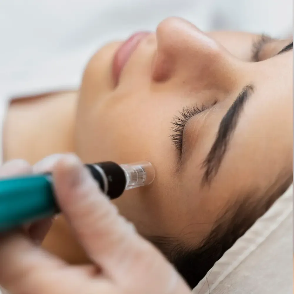 Was ist Mesotheraphie oder Mesolifting?